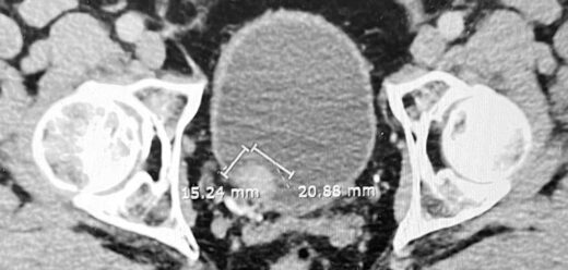 Bladder cancer